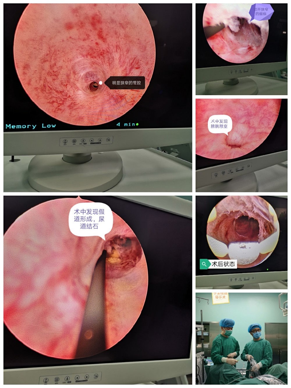 患者于40多年前骑跨伤后出现排尿不畅,20年前开始出现尿潴留,在其他
