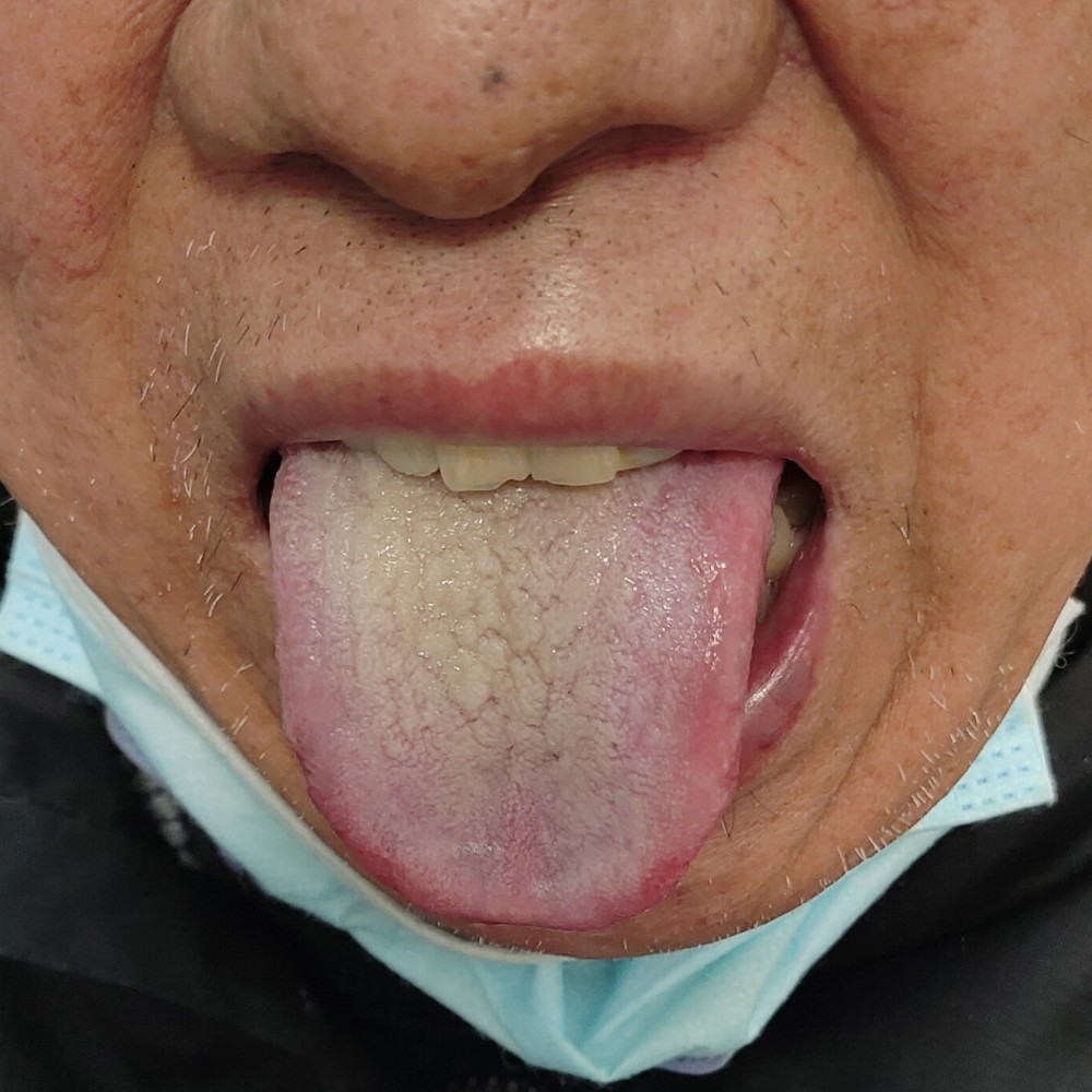 注重老年人痰,饮的治疗:老年人多患有慢支,copd,肺间质纤维化